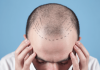How Many Grafts Needed for A Good HairTransplant