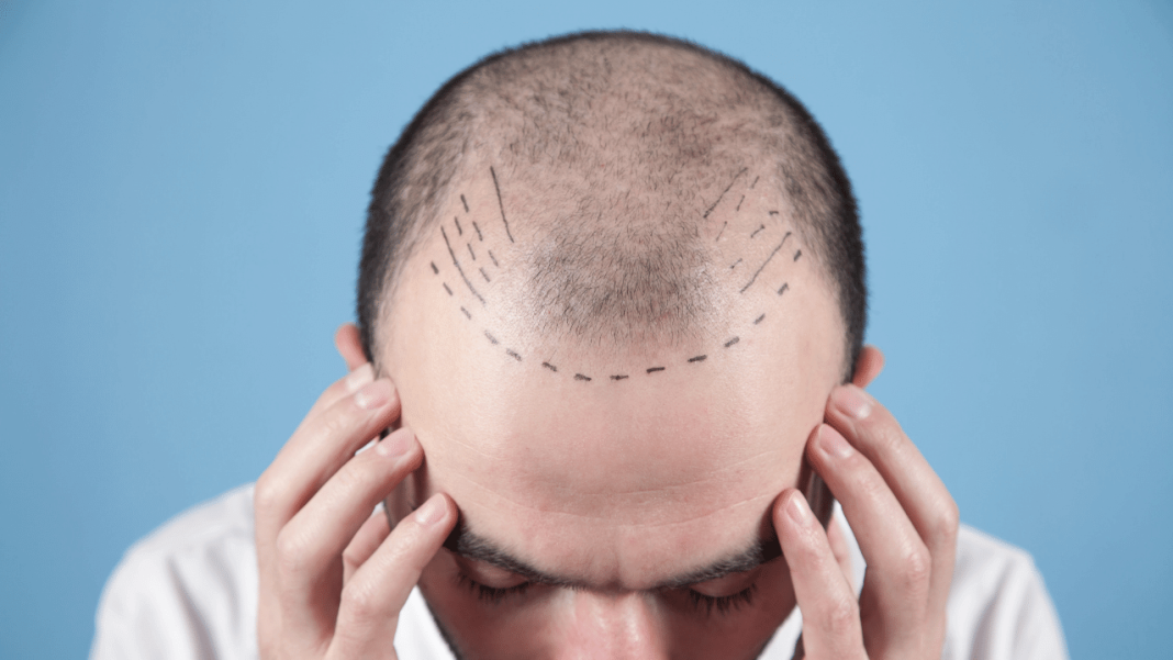 How Many Grafts Needed for A Good HairTransplant