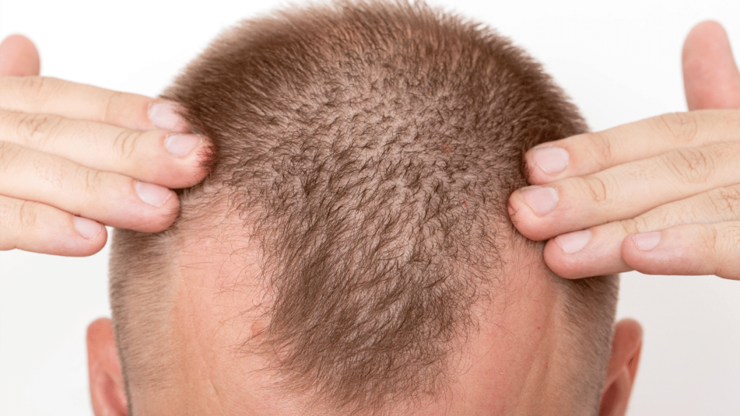 Why Do Men Experience Hair Loss?