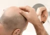 Is everyone suitable for hair transplantation