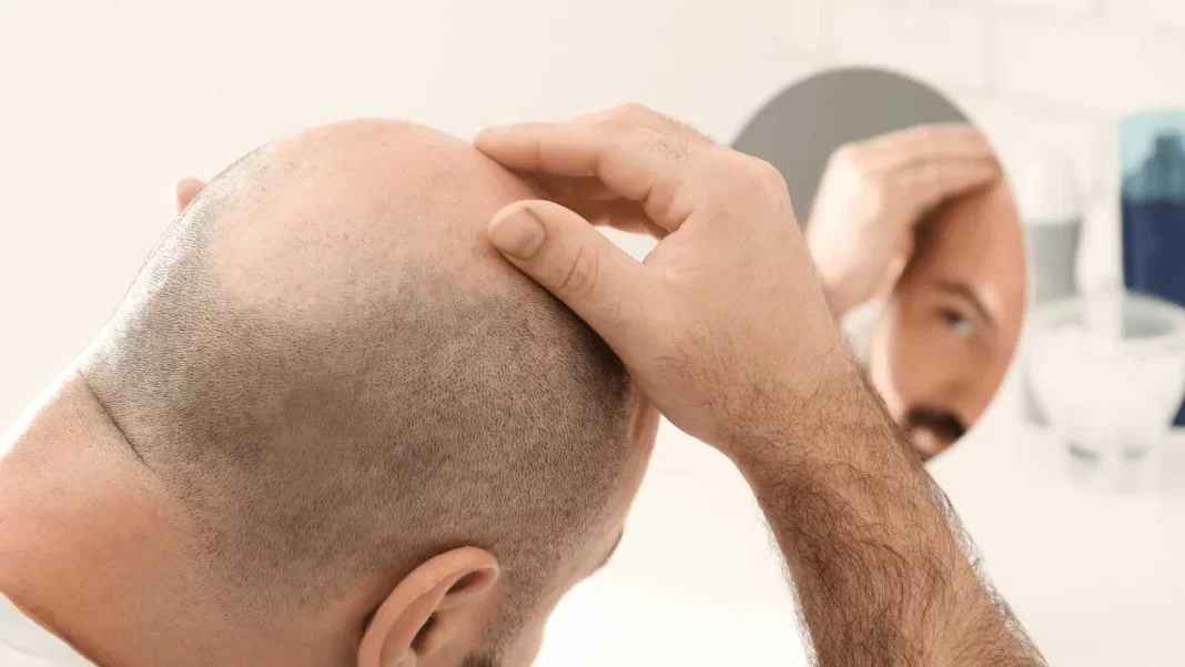 Is everyone suitable for hair transplantation