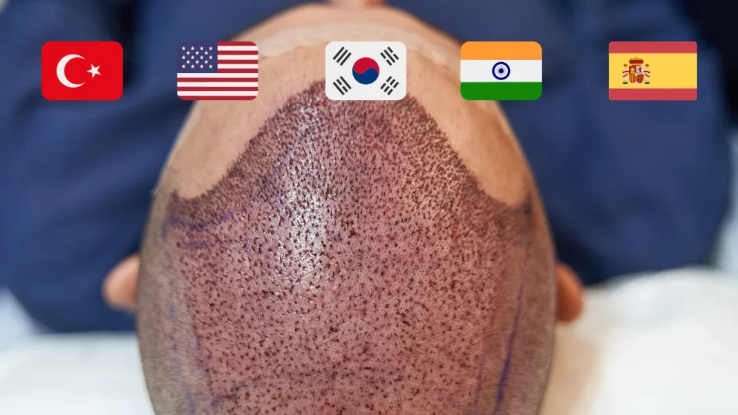 The Top 5 Countries for the Best Hair Transplant Results