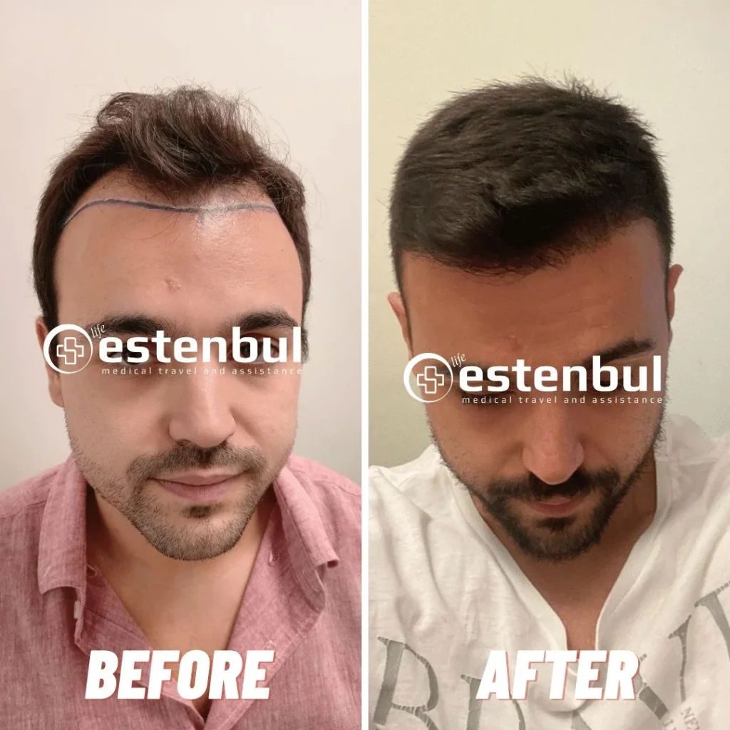 Estenbul Health Hair Transplant Before and After